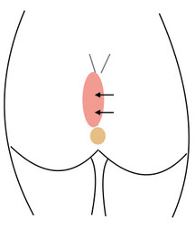 Karydakis operation pilonidal cyst