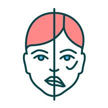 顔面神経麻痺の症状の顔のイラスト