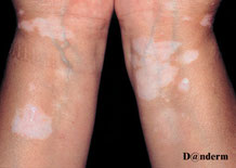 Plaques blanches de vitiligo sur des poignets