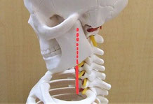 骨格模型でストレートネックを示した画像