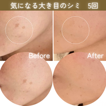 シミケア　ビフォーアフター