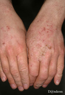 eczema irritatif des dos des deux mains