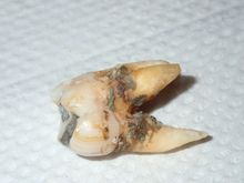 gum disease, periodontal disease.