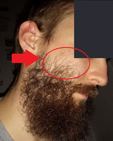 por que no sirve el minoxidil para barba