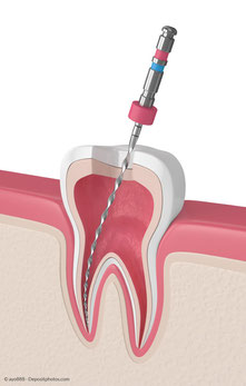 Gründlich wird das tote Gewebe entfernt, die Wurzelkanäle gereinigt, gespült und desinfiziert bevor der Zahn wieder verschlossen wird.