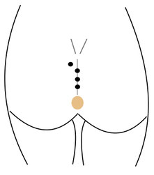 Karydakis operation pilonidal cyst