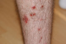 eczema nummulaire sur un mollet tres poilu