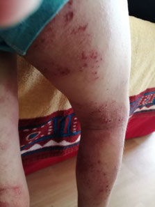 Photo d'eczéma surinfecte sur tout le membre inferieur