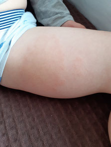 photo d'eczéma sec face interne de cuisse
