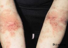 photo d'eczéma sévère des plis des bras