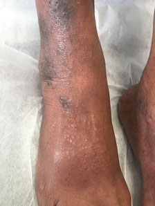 eczema violet cheville