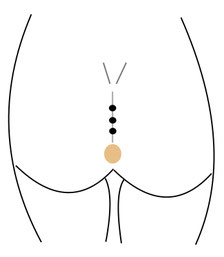 Limberg operation pilonidal cyst