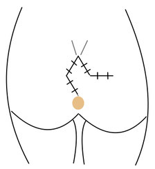 OP Limberg Steissbeinfistel (Sinus pilonidalis) -Sinus pilonidalis Zentrum Berlin