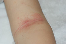 eczema du creux poplite leger