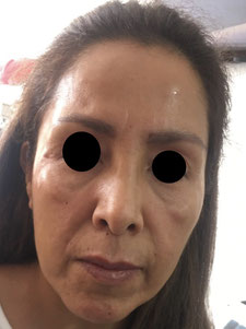 ANTES del TRATAMIENTO DE OJERAS y full face con acido hialuronico y Toxina Botulínica (Botox)