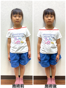 大井町駅前整骨院での子供整体を受けた子のビフォーアフター