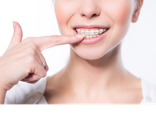 Type of Orthodontic Devices