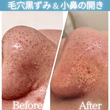 角質ケア　ビフォーアフター