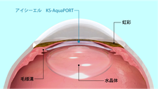 眼内レンズ手術方法4