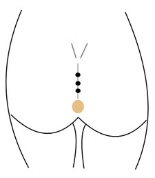 OP Limberg Steissbeinfistel (Sinus pilonidalis) -Sinus pilonidalis Zentrum Berlin