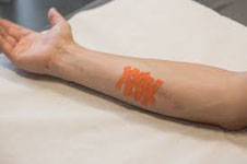 Medical taping bij littekens bij uw sportmasseur MdR Sportmassage Den Bosch