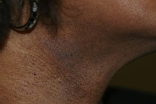 eczema lichénifié sur peau noire au niveau du cou