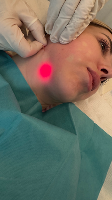 Endolift Ebert München