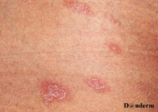pityriasis rose de gibert