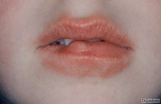 tic de lechage