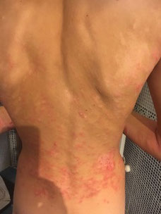 plaques rouges d'eczéma sur le dos d'un adolescent