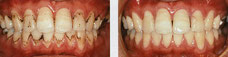 歯のクリーニング　バイオフィルムの除去