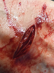 stab wound