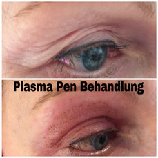 Plasma Pen Schlupflider Behandlung ohne OP - Pimp my Face -Hamburg - Bramfeld
