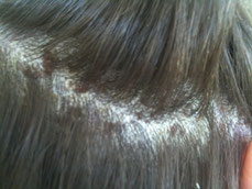 Scaly scalp. Scalp psoriasis