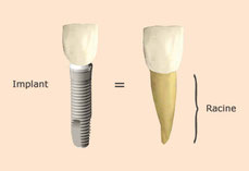 implant et racine dentaire