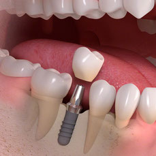 Natürliches Lächeln mit Implantat: Perfekter Ersatz für verlorenen Zahn, für ästhetische Zahnreihen und uneingeschränkte Lebensfreude.