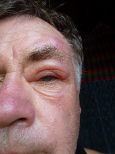 Bild: Stich am Auge