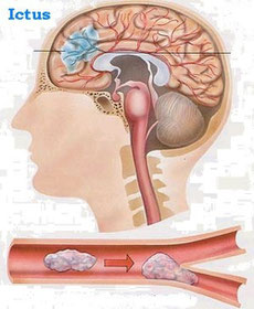 Infarto cerebral o ictus