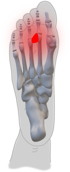Spreizfuß Morton Neurom