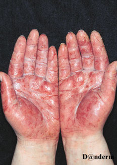 eczéma allergique aigu des paumes avec rougeur diffuse