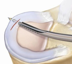 der meniskusschaden - Dr. Burchard im MedCenter Siegen