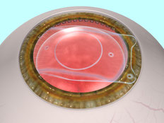 眼内レンズ手術方法3