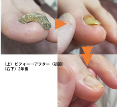 爪甲鉤彎症ケア　重複爪ケア