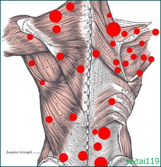 トリガーポイント治療