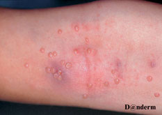 molluscum contagiosum sur une plaque d eczema