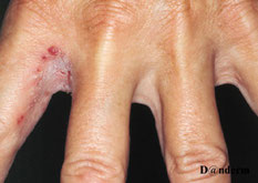 mycose entre les doigts de la main