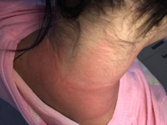 Bad allergy reaction to hair color at home - 2