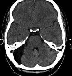 arachnoid cysta ct