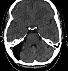 Arachnoid cyst CT