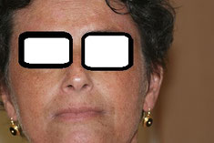photo eczéma visage